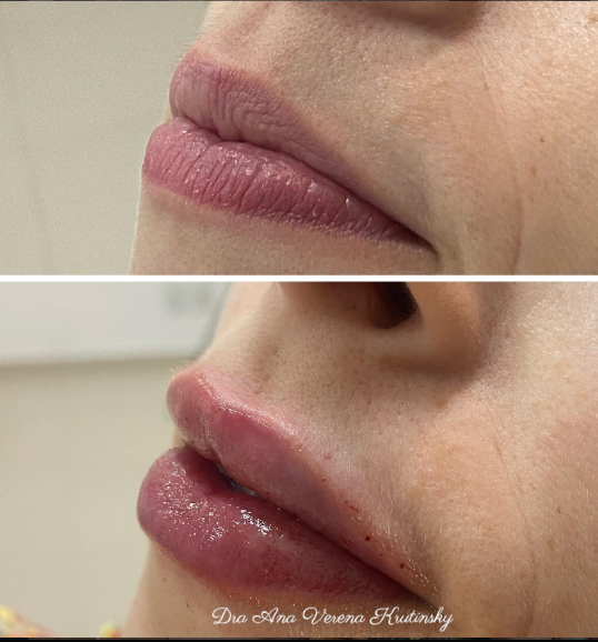 Preenchimento labial