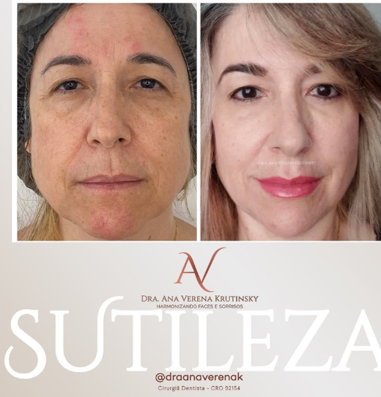 Harmonização facial — full face