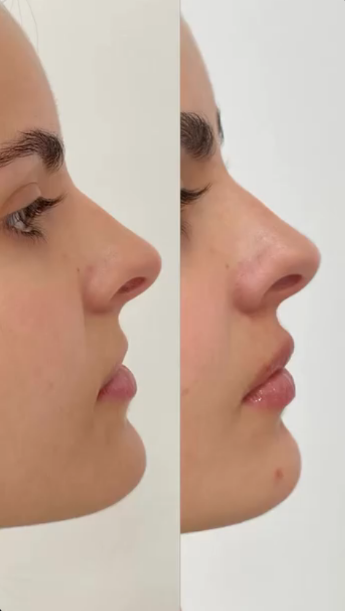 Preenchimento labial — perfil